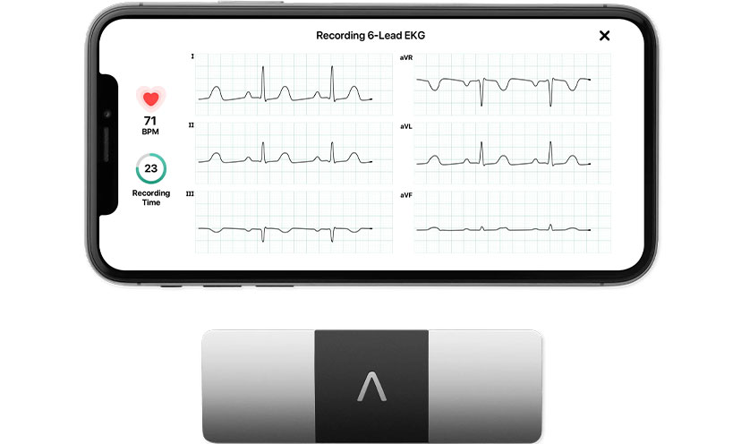 Kardia device and smartphone screen with measurements